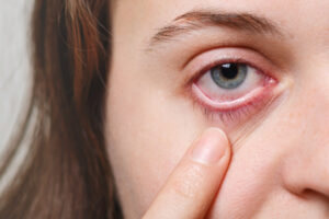 Yeux rouges la causes : découvrez les raisons courantes et rares des yeux rouges, comment les soulager efficacement, et quand consulter un spécialiste.